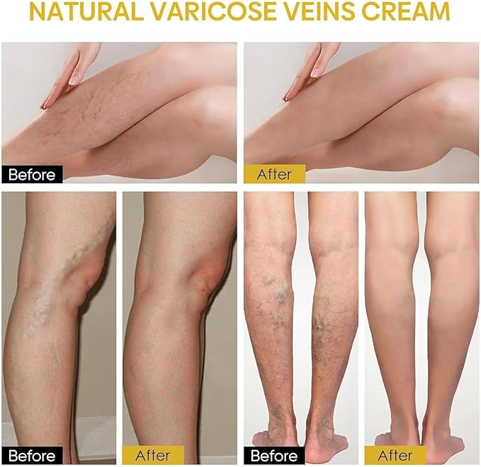 BlushMint Bee Venom Spider Veins Spray Pack of 2