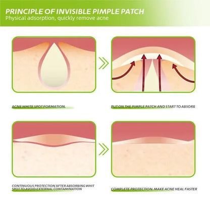 BlushMint Acne Pimple Patch (72 Pieces)